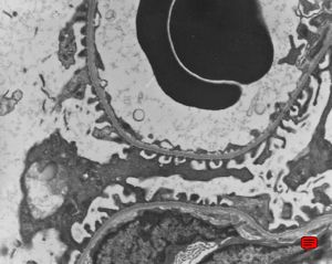 M,13y. | thin basement membrane syndrome M,13y. | thin basement membrane syndrome